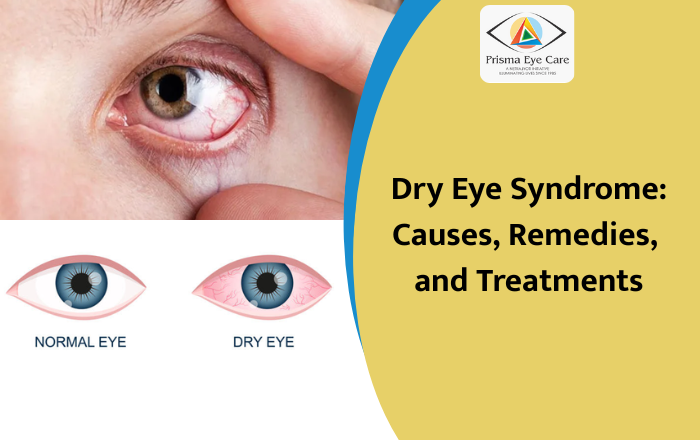 Dry Eye Syndrome: Causes, Home Remedies, and Effective Medical Treatments